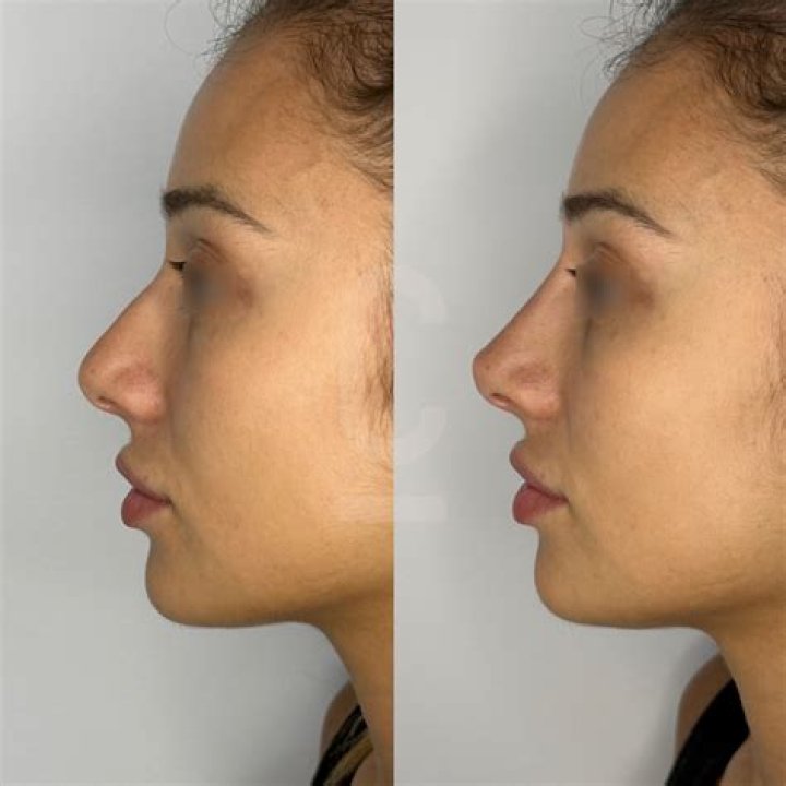 Affordable Non-Surgical Rhinoplasty: Discover Affordable Prices