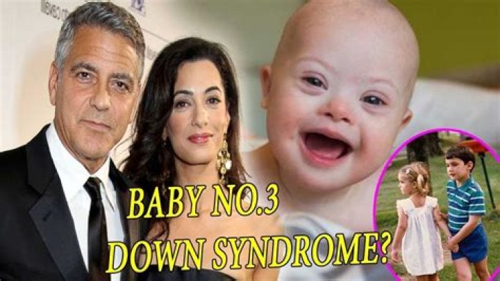 George Clooney's Twins And Down Syndrome: Exploring The Facts