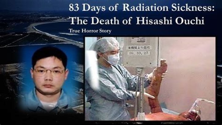 Horrific Radiation Poisoning: The Tragic Case Of Hisashi Ouchi