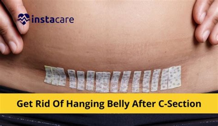 The Ultimate Guide To The Best Panties After A C-Section: Comfort And Support For Your Recovery