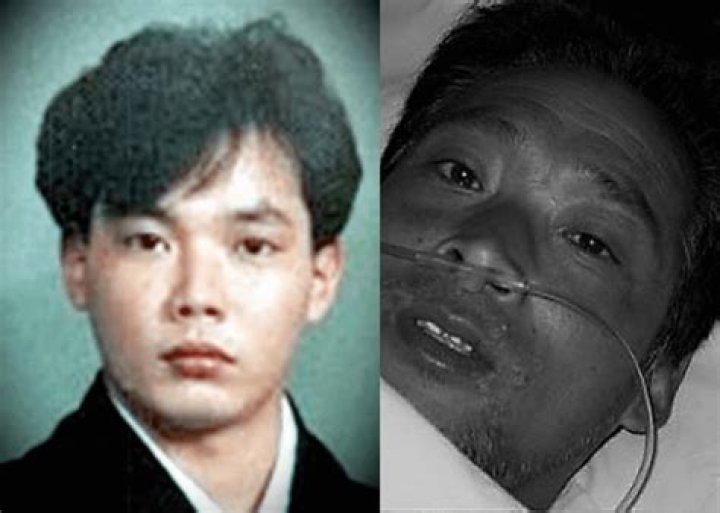 The Unseen Tragedy: Hisashi Ouchi's Severe Facial Deformities